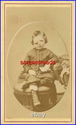 1800s RARE MEDICAL FREAK CDV PHOTO Boy With Large Eyeball VG